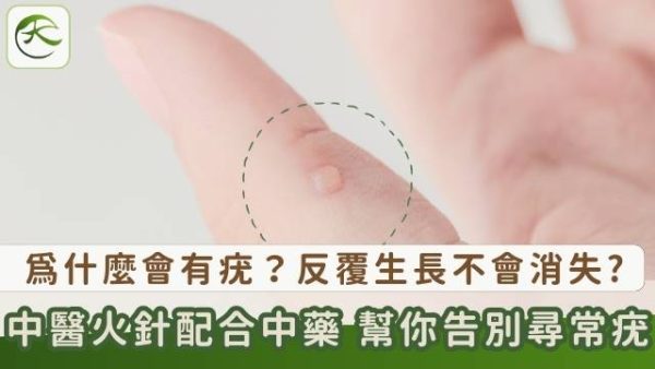 告別煩人尋常疣!中醫火針治療+消疣中藥方幫你速速脫疣 – 醫天圓中醫診所