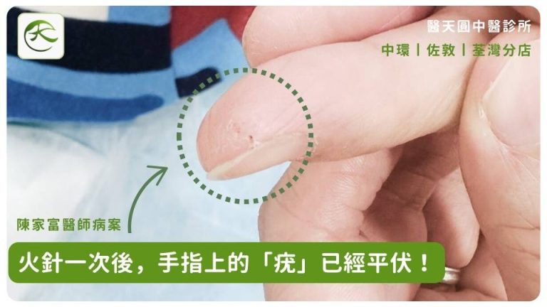 告別煩人尋常疣!中醫火針治療+消疣中藥方幫你速速脫疣 – 醫天圓中醫診所